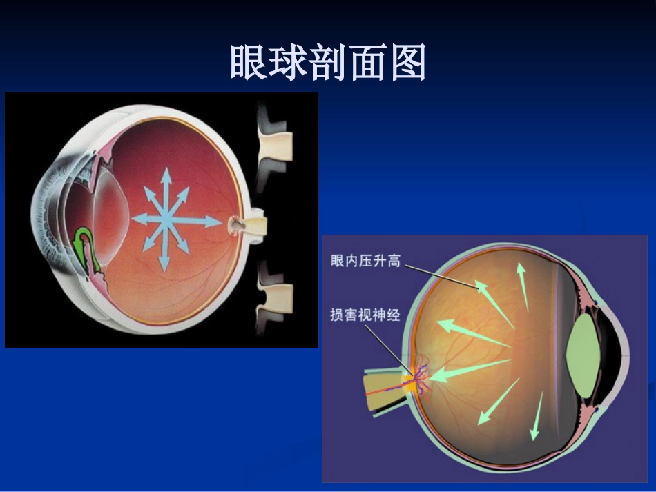 急性闭角型青光眼的诊断与治疗剖析_第4页