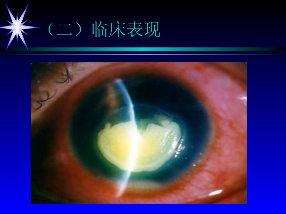 角膜炎——眼科学课件_第13页