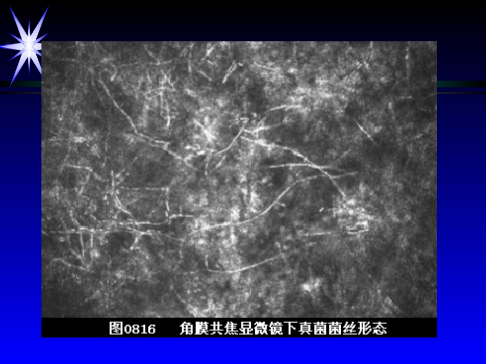 角膜炎——眼科学课件_第15页
