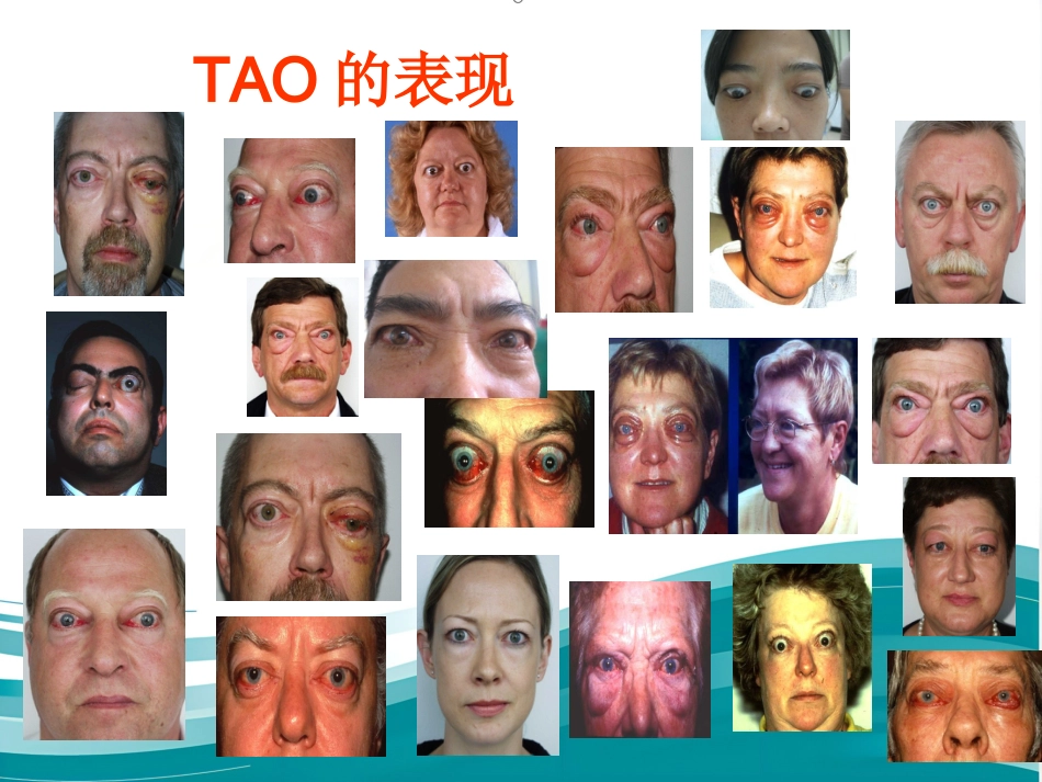 甲状腺相关性眼病的诊治_第3页