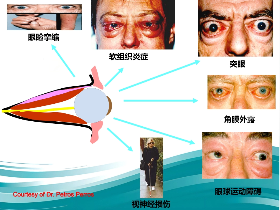甲状腺相关性眼病的诊治_第4页