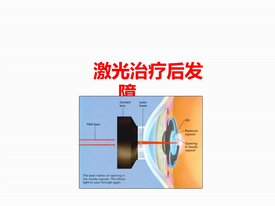 激光治疗后发性白内障_第1页