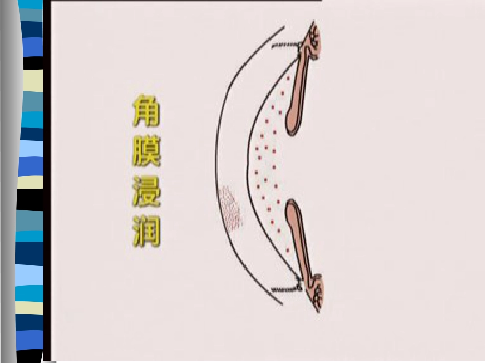 角膜病护理PPT课件_第5页