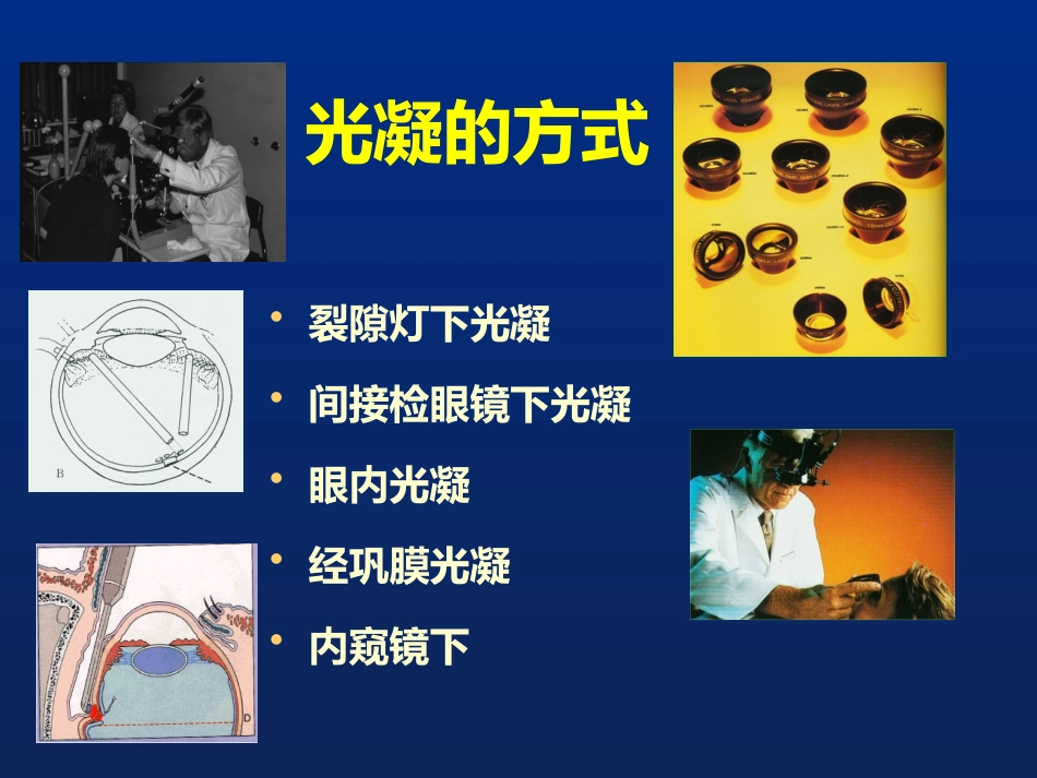 激光治疗在眼科的应用_第15页