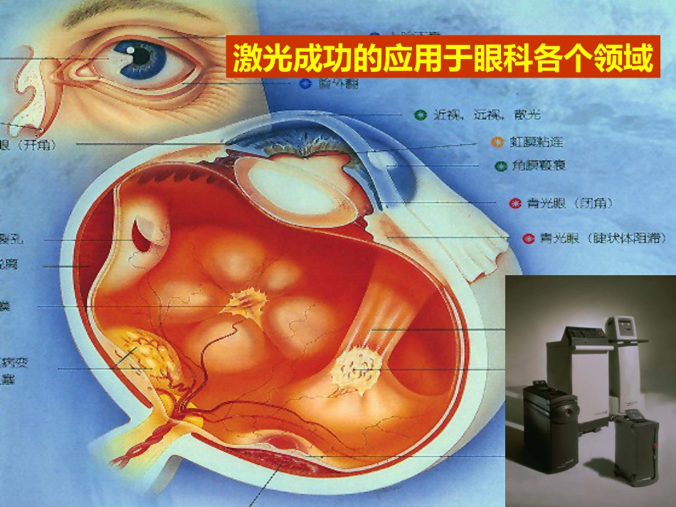 激光治疗在眼科的应用_第4页