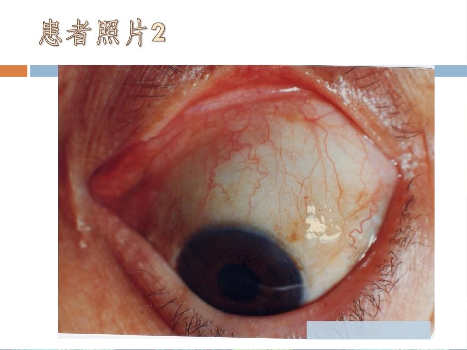 急性出血性结膜炎讲座_第10页
