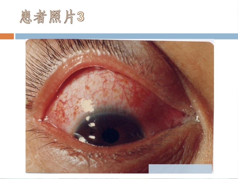 急性出血性结膜炎讲座_第11页