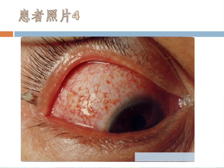 急性出血性结膜炎讲座_第12页