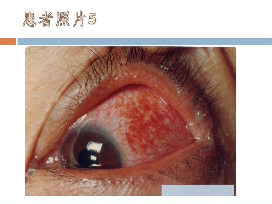 急性出血性结膜炎讲座_第13页