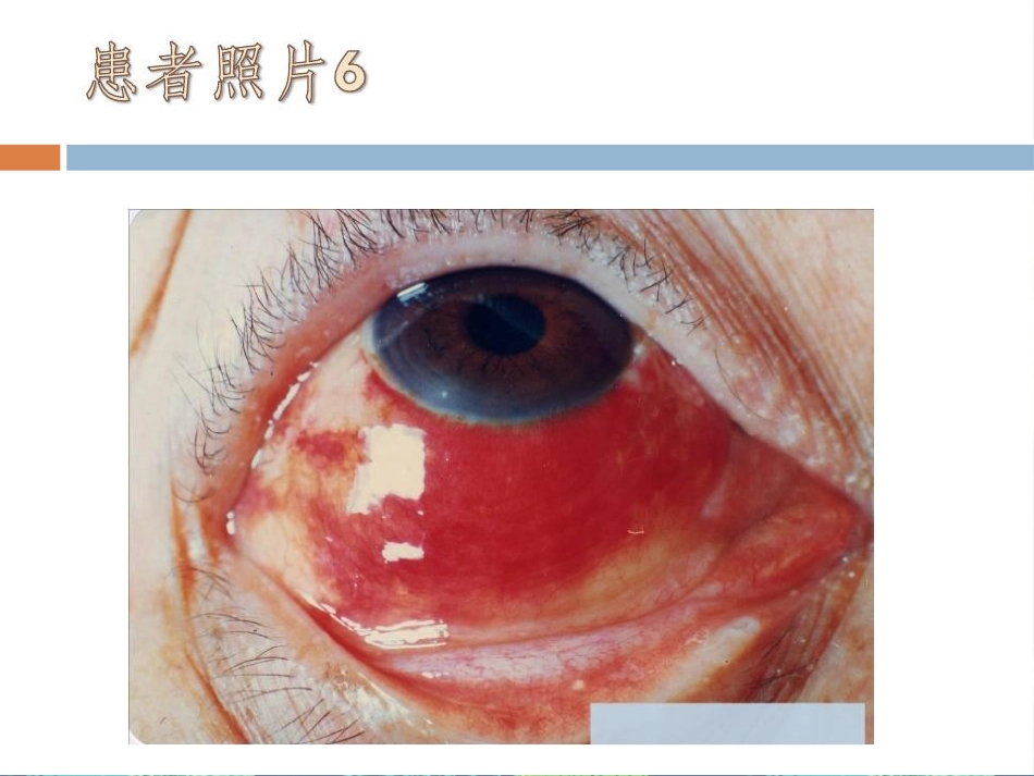 急性出血性结膜炎讲座_第14页