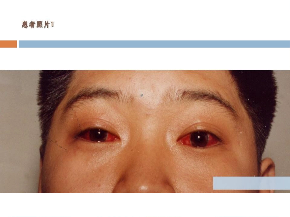 急性出血性结膜炎讲座_第9页