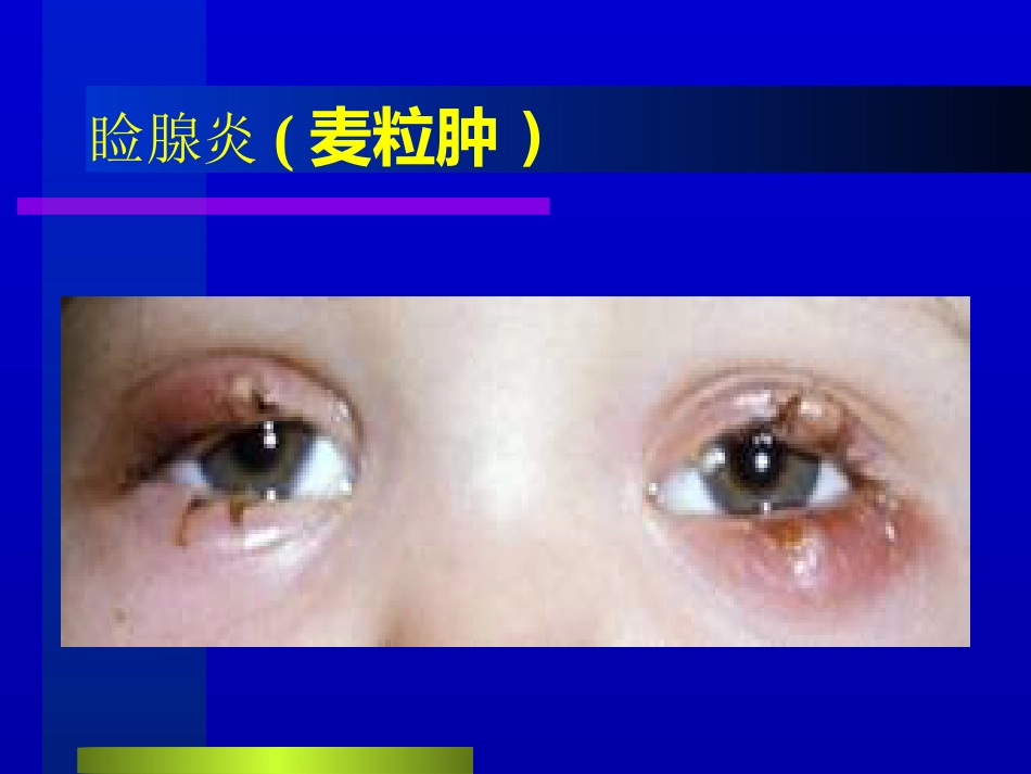 睑腺炎-麦粒肿_第4页