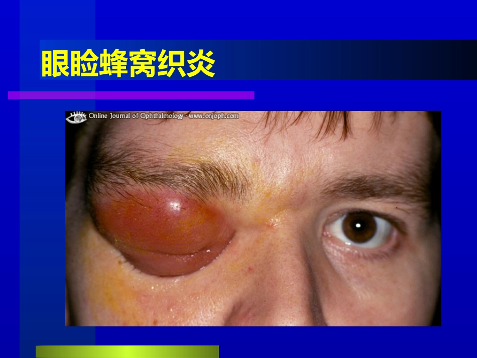 睑腺炎-麦粒肿_第8页
