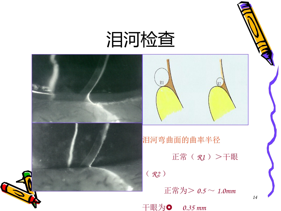 干眼症患者必看—干眼症诊断和治疗_第14页