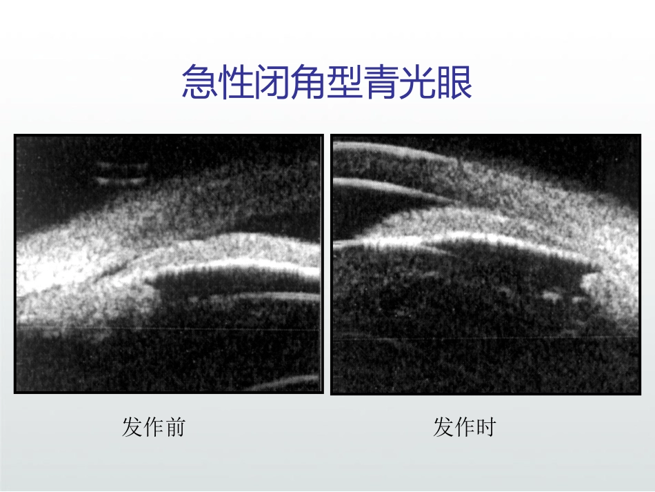 急性闭角型青光眼PPT_第10页
