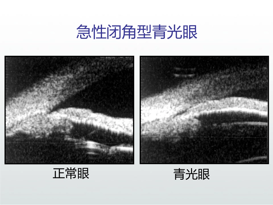急性闭角型青光眼PPT_第8页