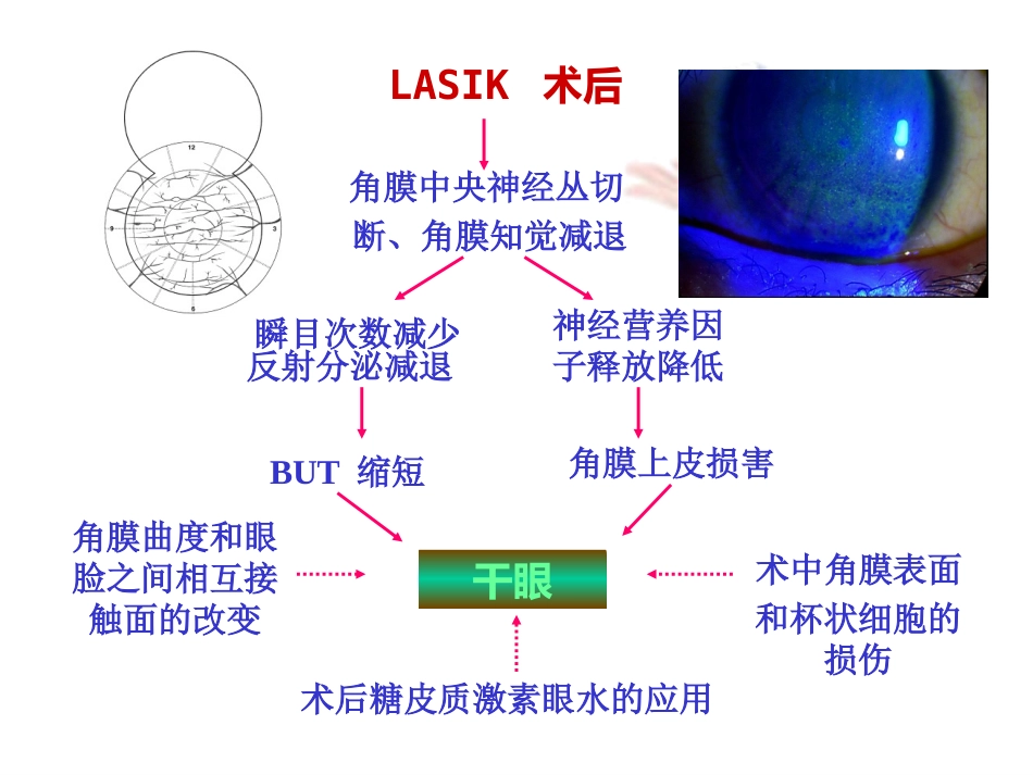 干眼诊断治疗的新进展_第14页
