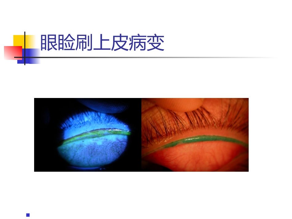 干眼诊断及治疗新进展讲义北京_第12页