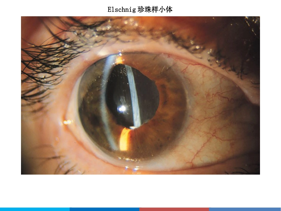 后发性白内障_第10页