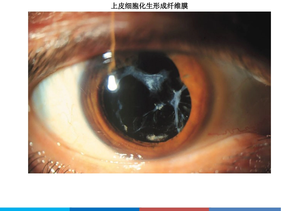 后发性白内障_第11页