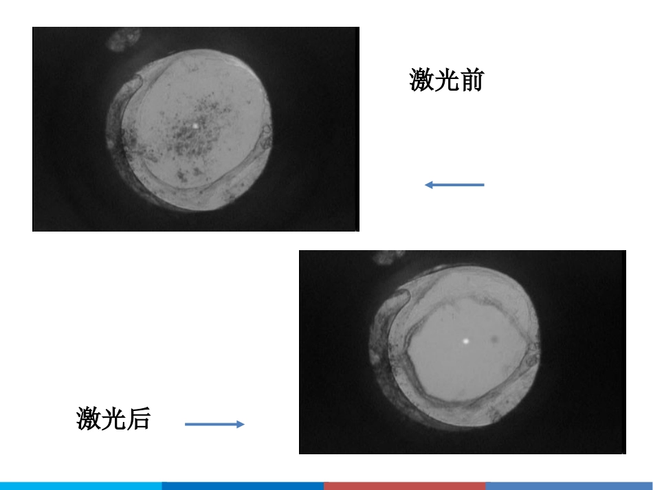 后发性白内障_第15页