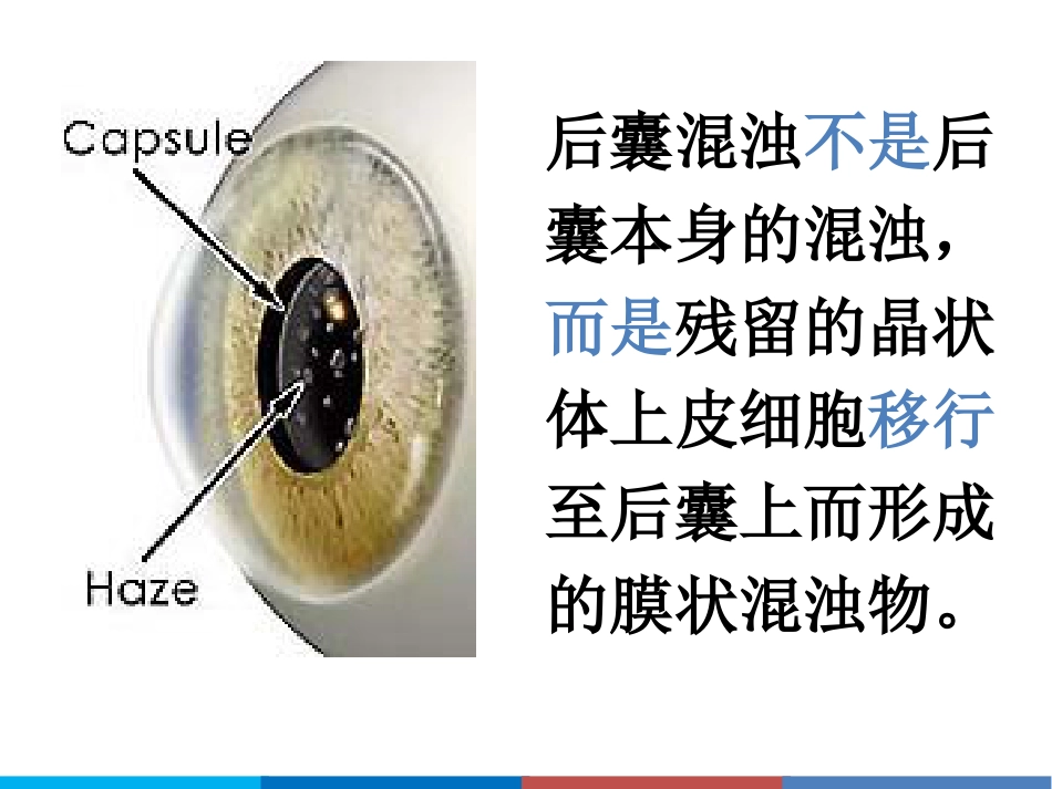 后发性白内障_第8页