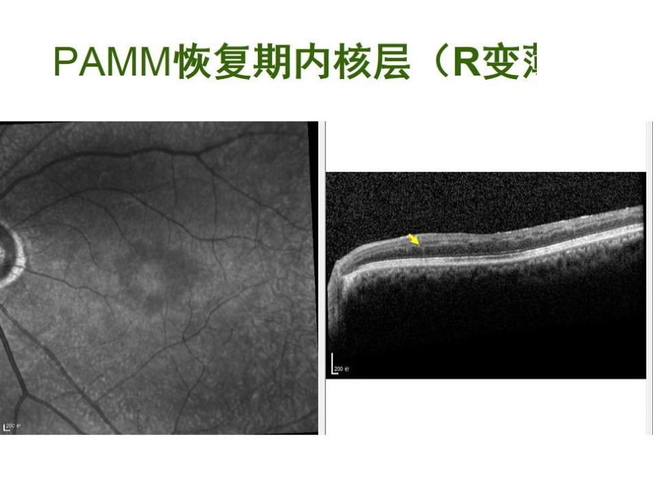 急性旁中心中层黄斑病变(PAMM)与急性黄斑神经视网膜病变(AMN)_第11页