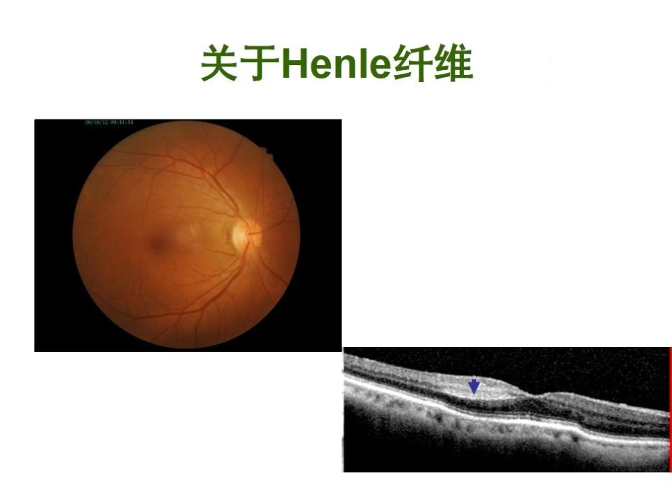 急性旁中心中层黄斑病变(PAMM)与急性黄斑神经视网膜病变(AMN)_第12页
