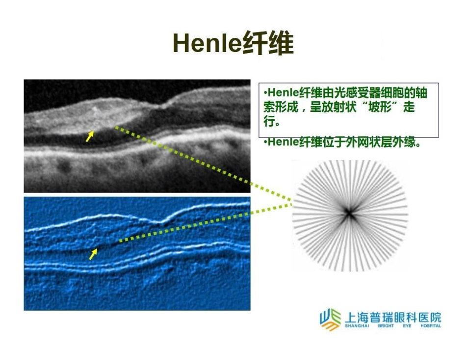急性旁中心中层黄斑病变(PAMM)与急性黄斑神经视网膜病变(AMN)_第13页