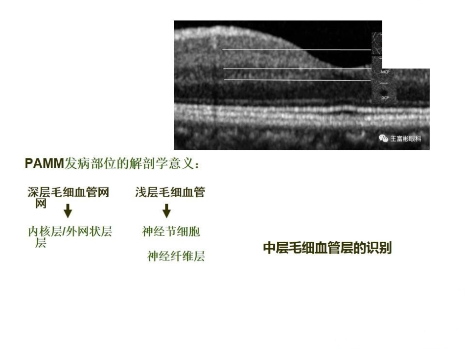 急性旁中心中层黄斑病变(PAMM)与急性黄斑神经视网膜病变(AMN)_第4页