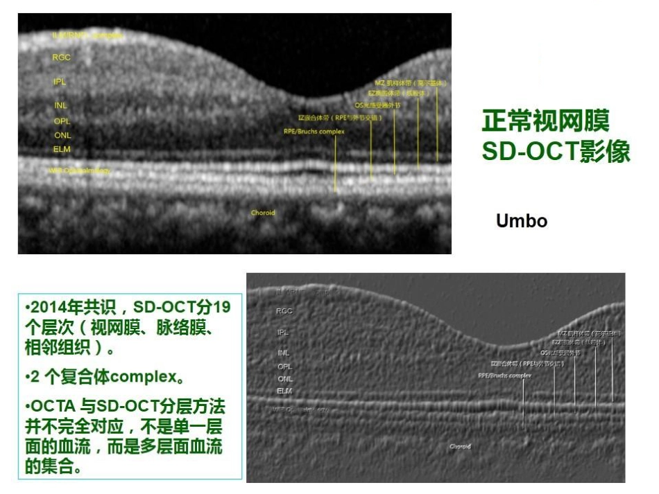 急性旁中心中层黄斑病变(PAMM)与急性黄斑神经视网膜病变(AMN)_第6页