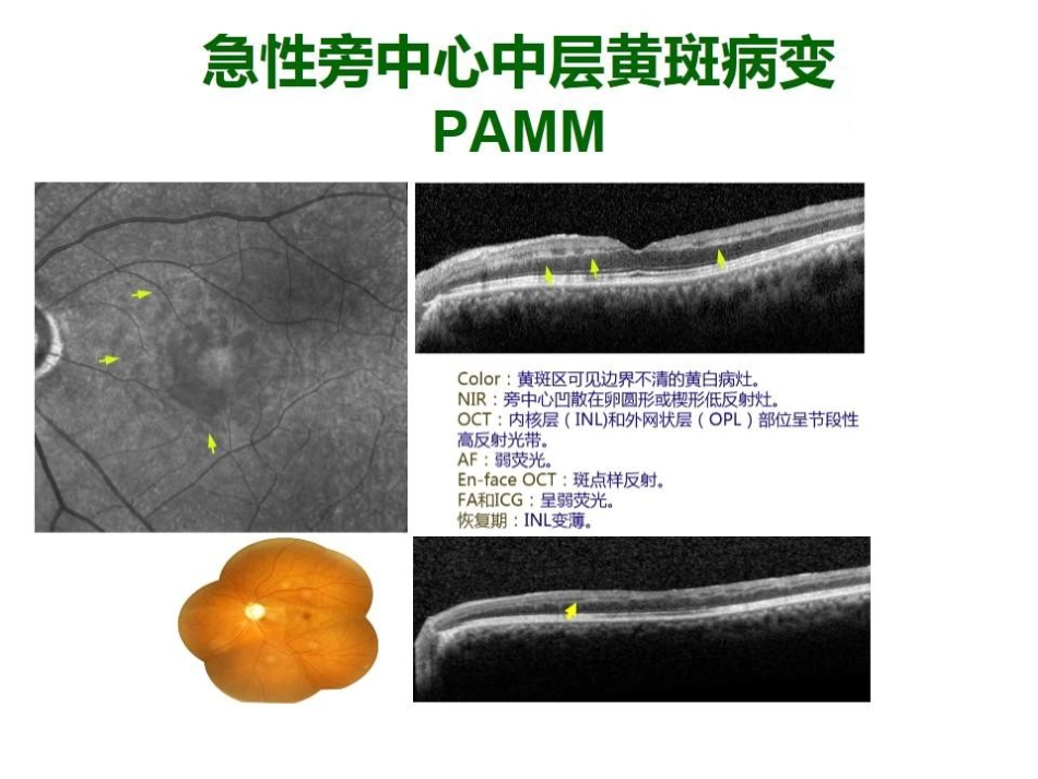 急性旁中心中层黄斑病变(PAMM)与急性黄斑神经视网膜病变(AMN)_第7页