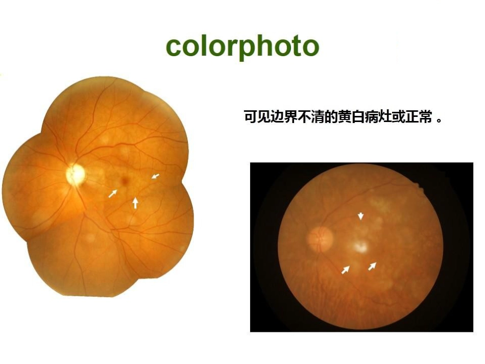 急性旁中心中层黄斑病变(PAMM)与急性黄斑神经视网膜病变(AMN)_第8页
