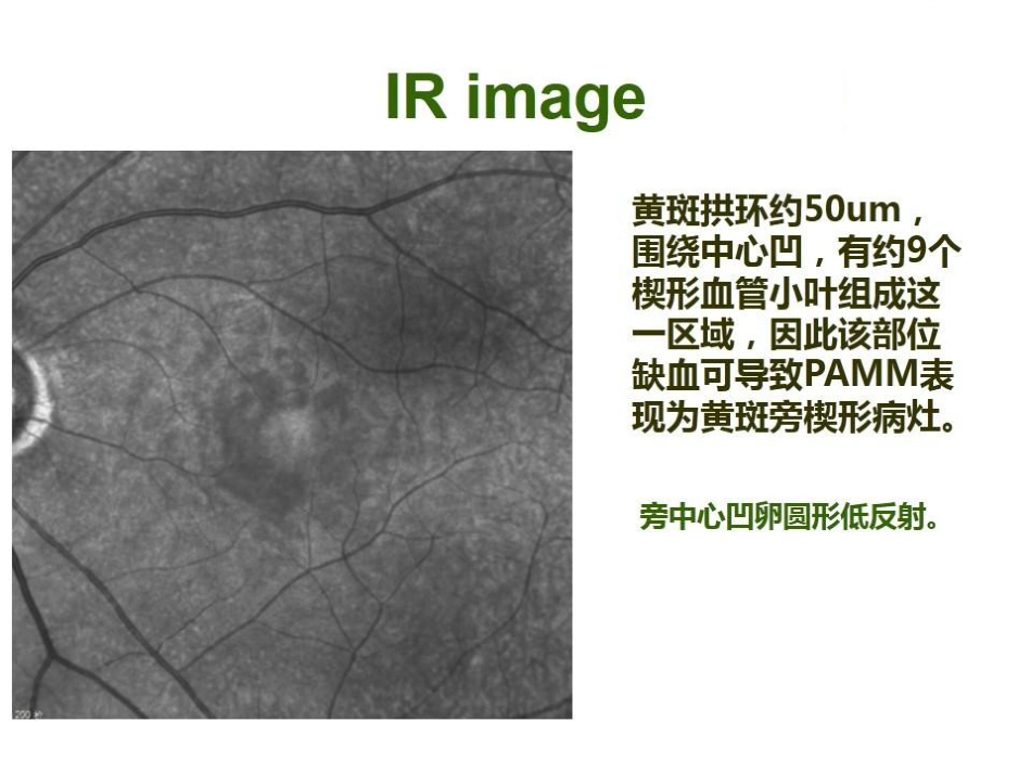 急性旁中心中层黄斑病变(PAMM)与急性黄斑神经视网膜病变(AMN)_第9页