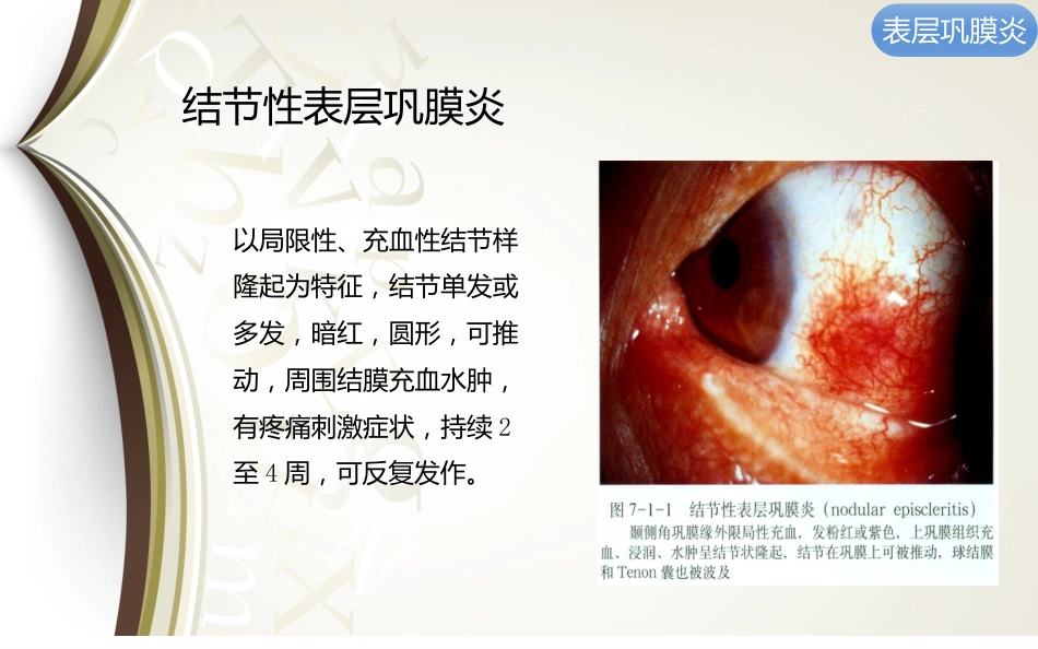 巩膜炎分享资料_第8页