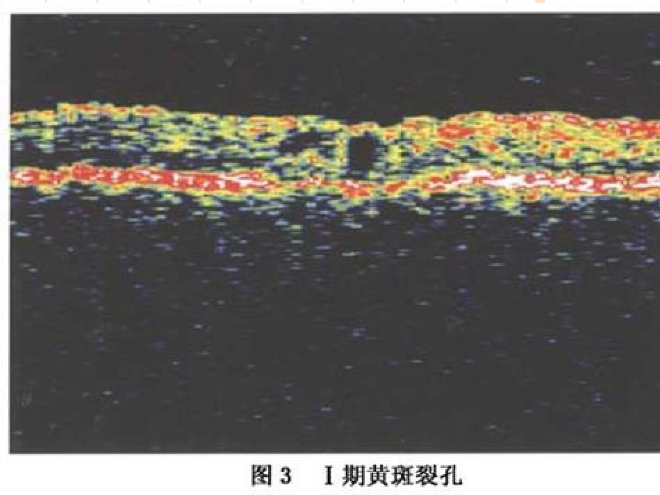 黄斑裂孔性视网膜脱离_第5页