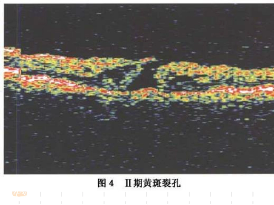 黄斑裂孔性视网膜脱离_第6页