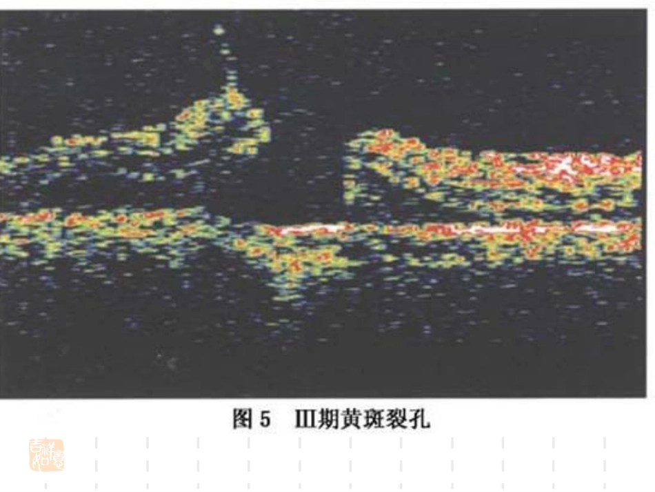 黄斑裂孔性视网膜脱离_第7页