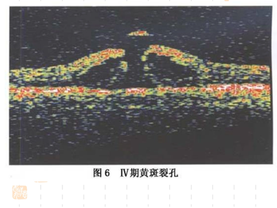 黄斑裂孔性视网膜脱离_第8页