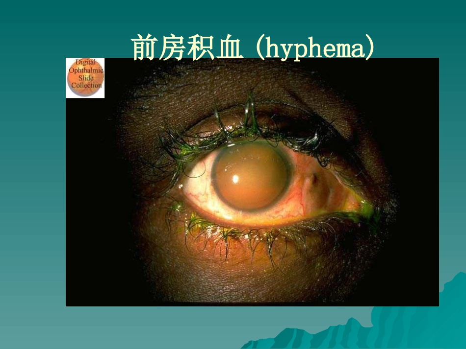 角膜病讲义_第15页
