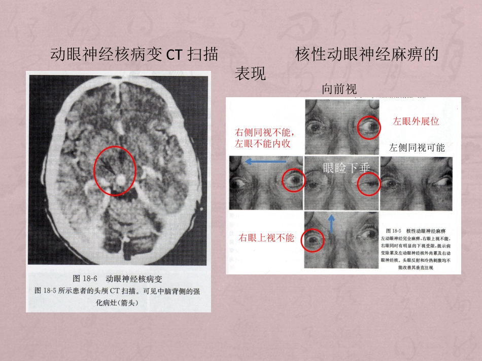 核性和核下性眼球运动障碍_第10页