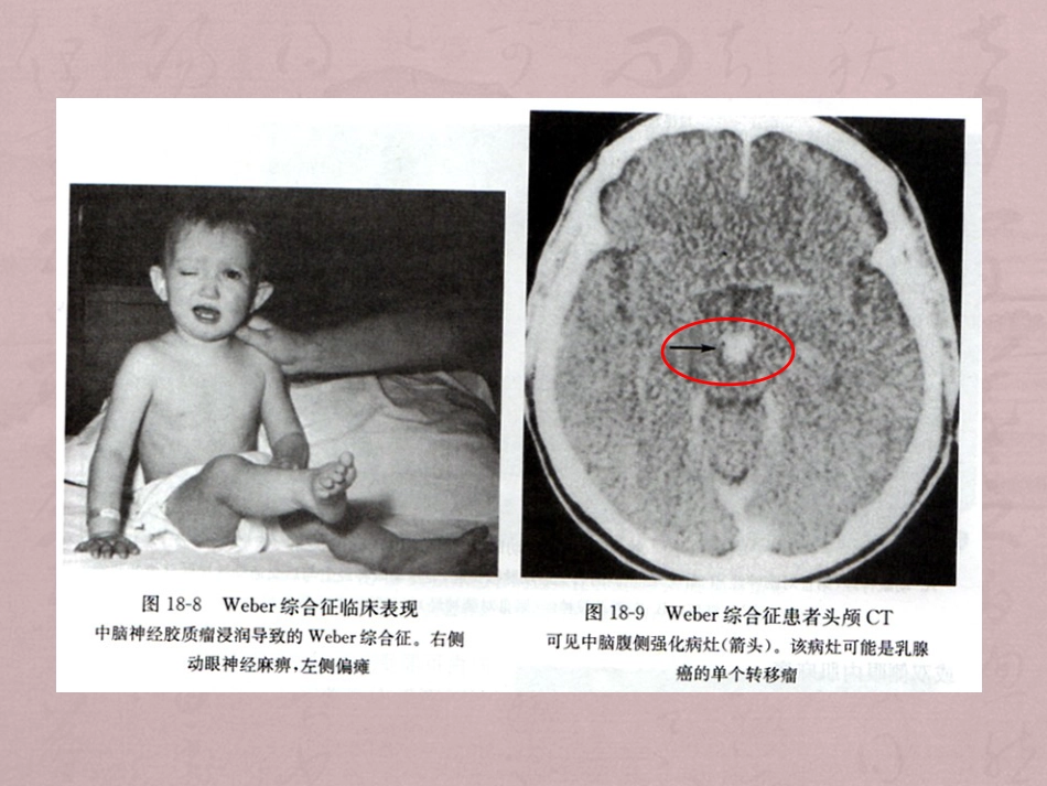 核性和核下性眼球运动障碍_第13页
