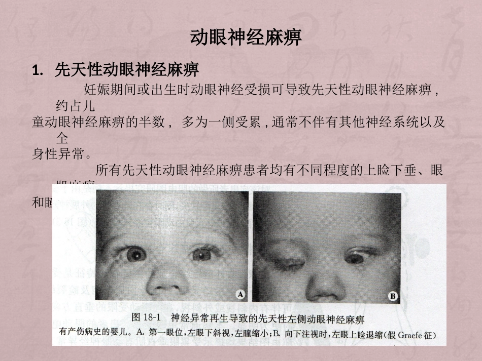 核性和核下性眼球运动障碍_第6页