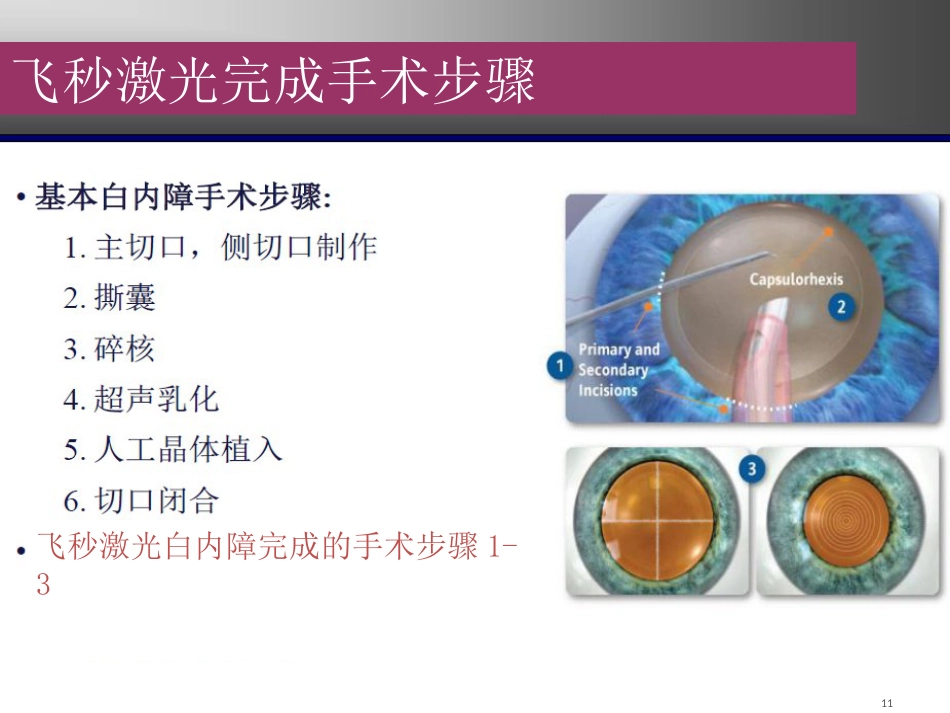 飞秒激光辅助白内障超声乳化联合toricIOL联合术分析_第11页