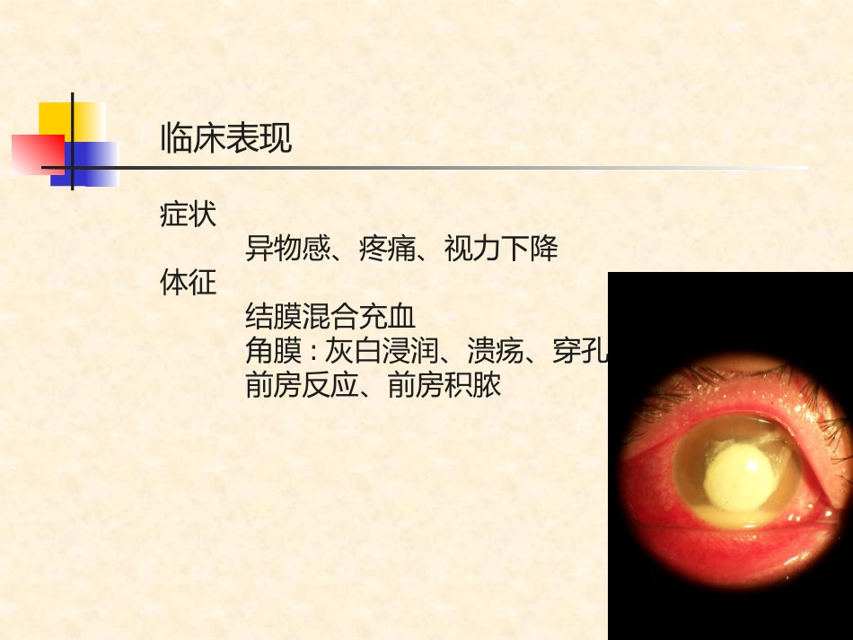 角膜炎的诊断与治疗_第8页