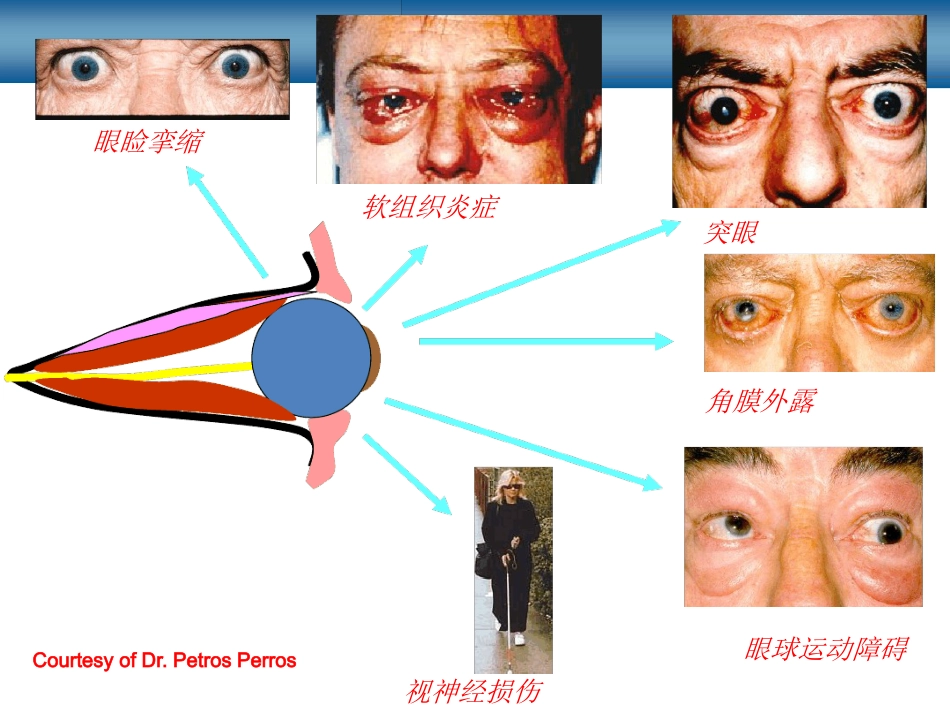 甲状腺相关性眼病_第14页