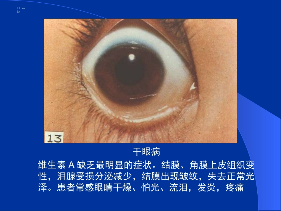干眼病维生素A缺乏最明显的症状。结膜、角膜上皮组织变性,泪腺_第2页