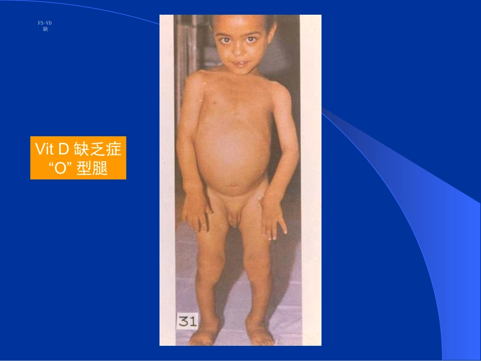 干眼病维生素A缺乏最明显的症状。结膜、角膜上皮组织变性,泪腺_第3页