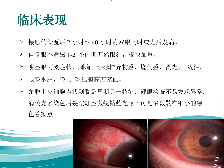 急性出血性结膜炎防治_第5页
