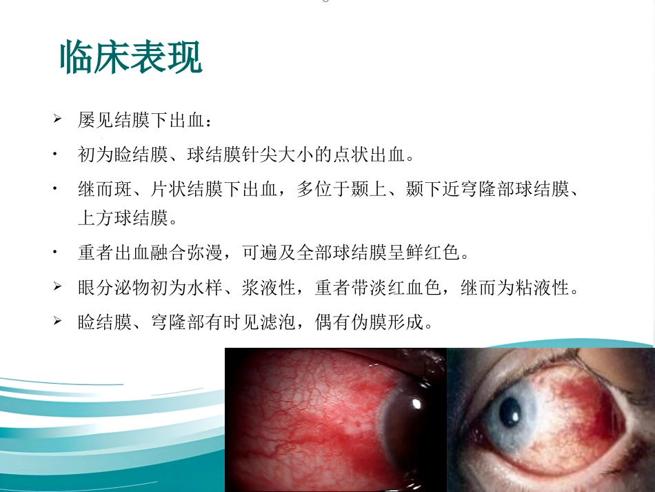 急性出血性结膜炎防治_第6页